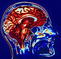 МРТ головного мозга при диагностике эпилепсии и при поражении черепно-мозговых нервов
